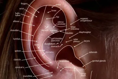 auriculoterapia que es?